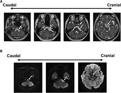 A simple combined approach using anterior transpetrosal and retrosigmoid approach: A case report